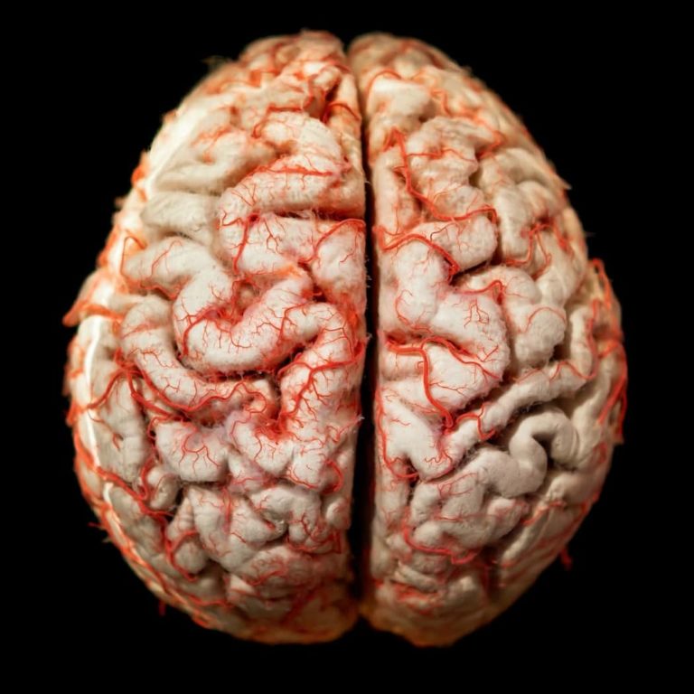 Enfermedad De Huntington Una Extraña Patología Que Afecta El Cerebro 7635